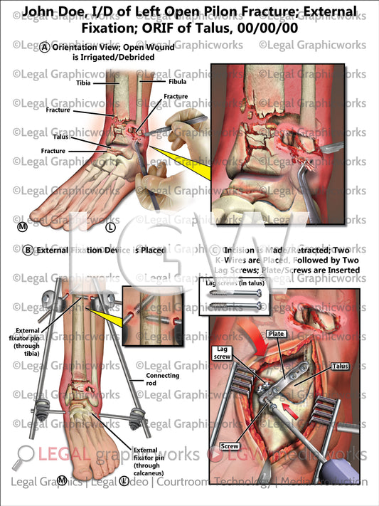 I/D of Left Open Pilon Fracture; External Fixation; ORIF of Talus