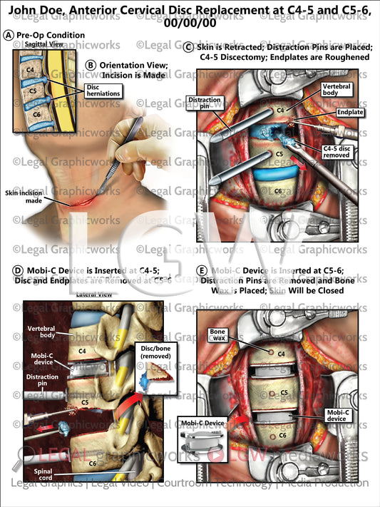 Anterior Cervical Disc Replacement at C4-5 and C5-6