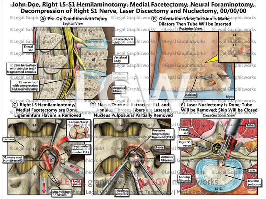 Right L5-S1 Hemilaminotomy, Medial Facetectomy, Neural Foraminotomy, Decompression of Right S1 Nerve, Laser Discectomy and Nuclectomy