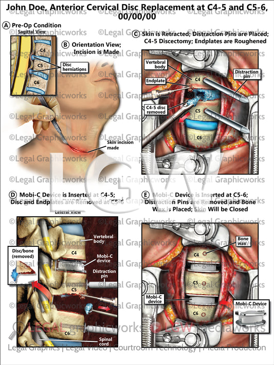 Anterior Cervical Disc Replacement at C4-5 and C5-6