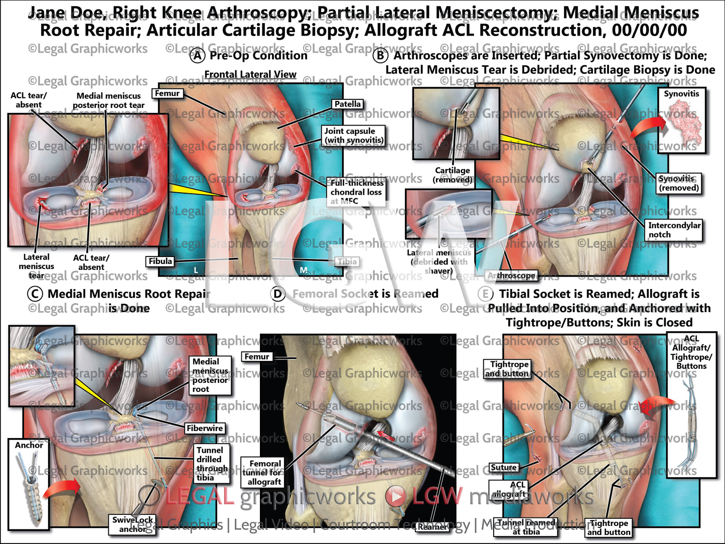 Right Knee Arthroscopy; Partial Lateral Meniscectomy; Medial Meniscus Root Repair; Articular Cartilage Biopsy; Allograft ACL Reconstruction