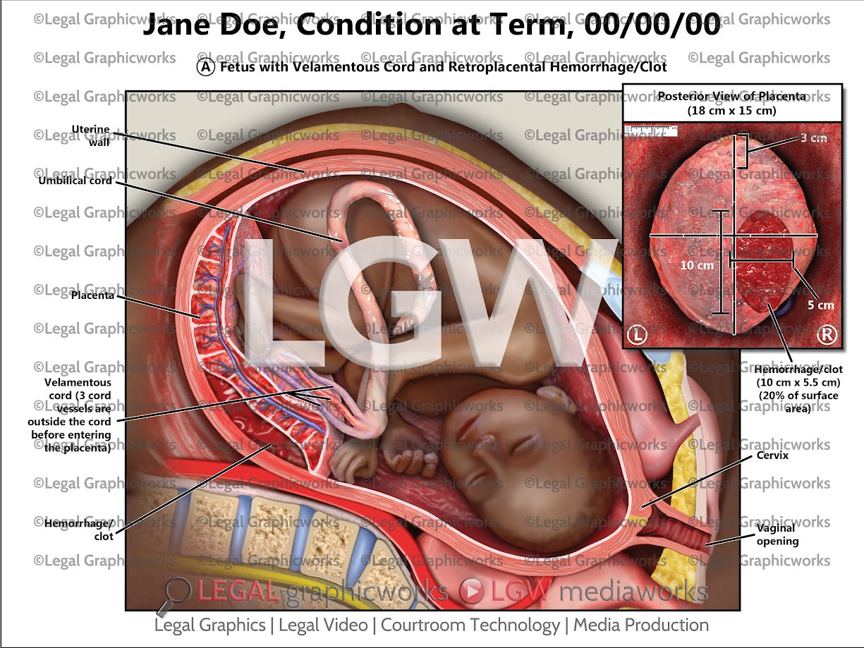 Condition at Term