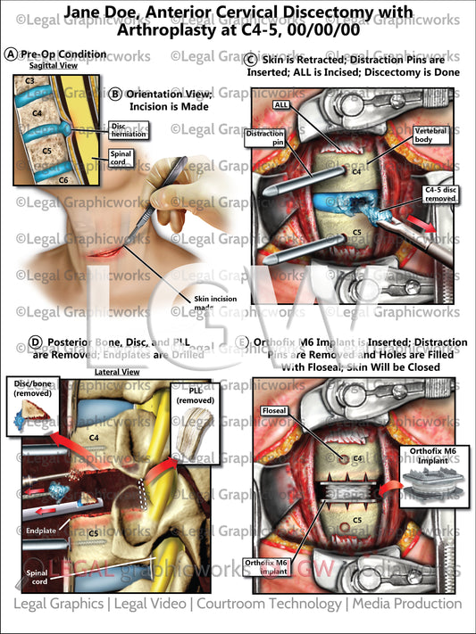 Anterior Cervical Discectomy with Arthroplasty at C4-5
