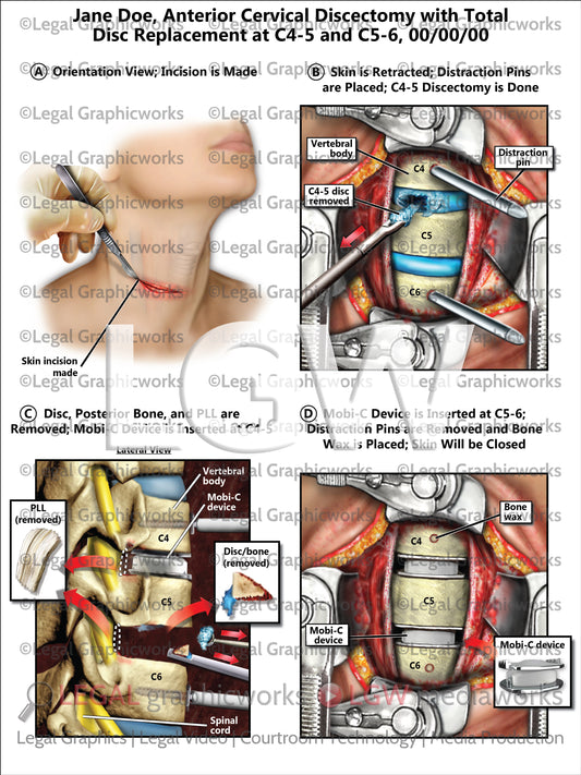 Anterior Cervical Discectomy with Total Disc Replacement at C4-5 and C5-6