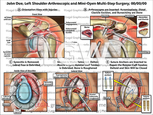 Left Shoulder Arthroscopic and Mini-Open Multi-Step Surgery