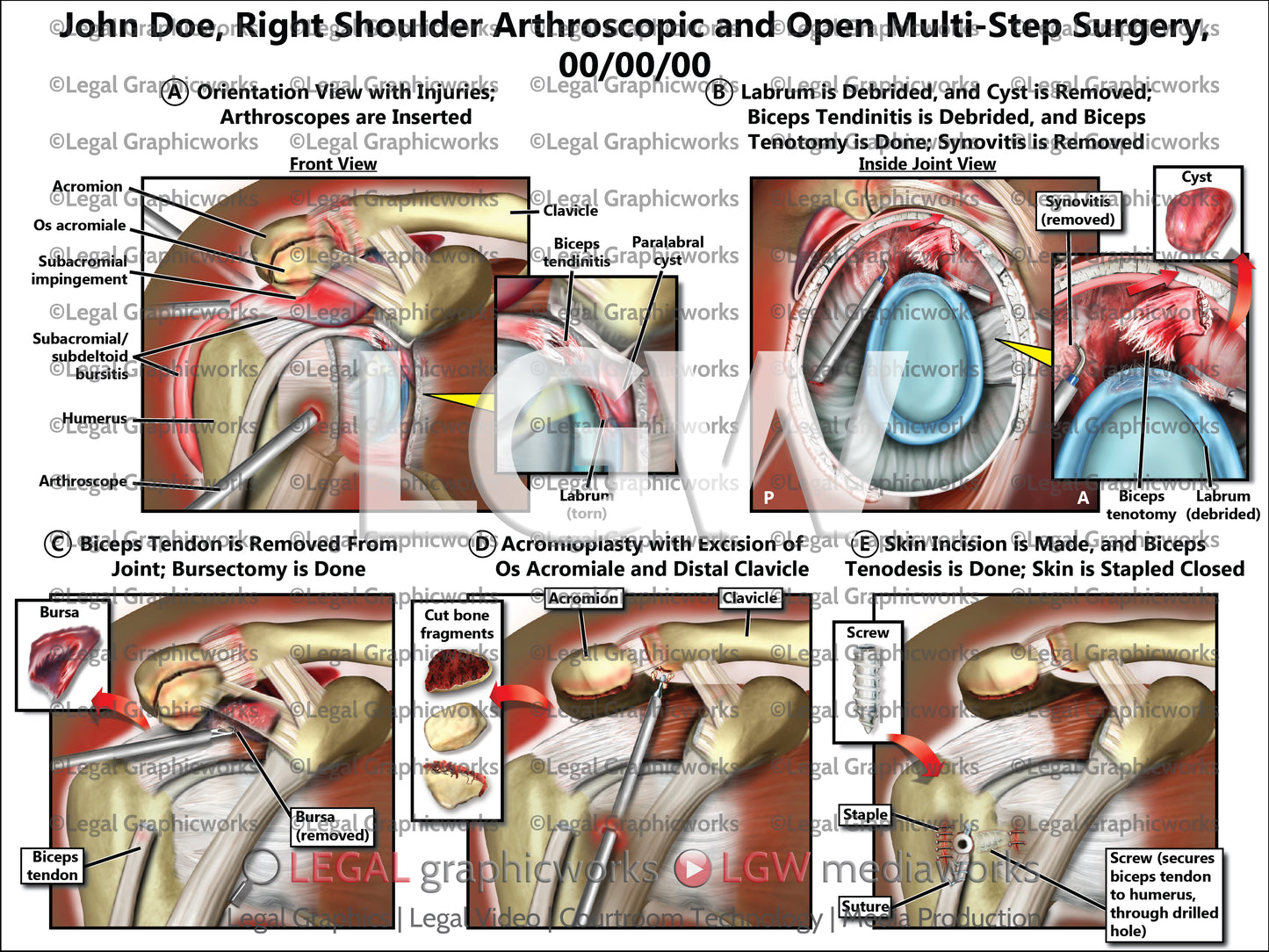Right Shoulder Arthroscopic and Open Multi-Step Surgery