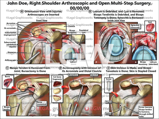Right Shoulder Arthroscopic and Open Multi-Step Surgery