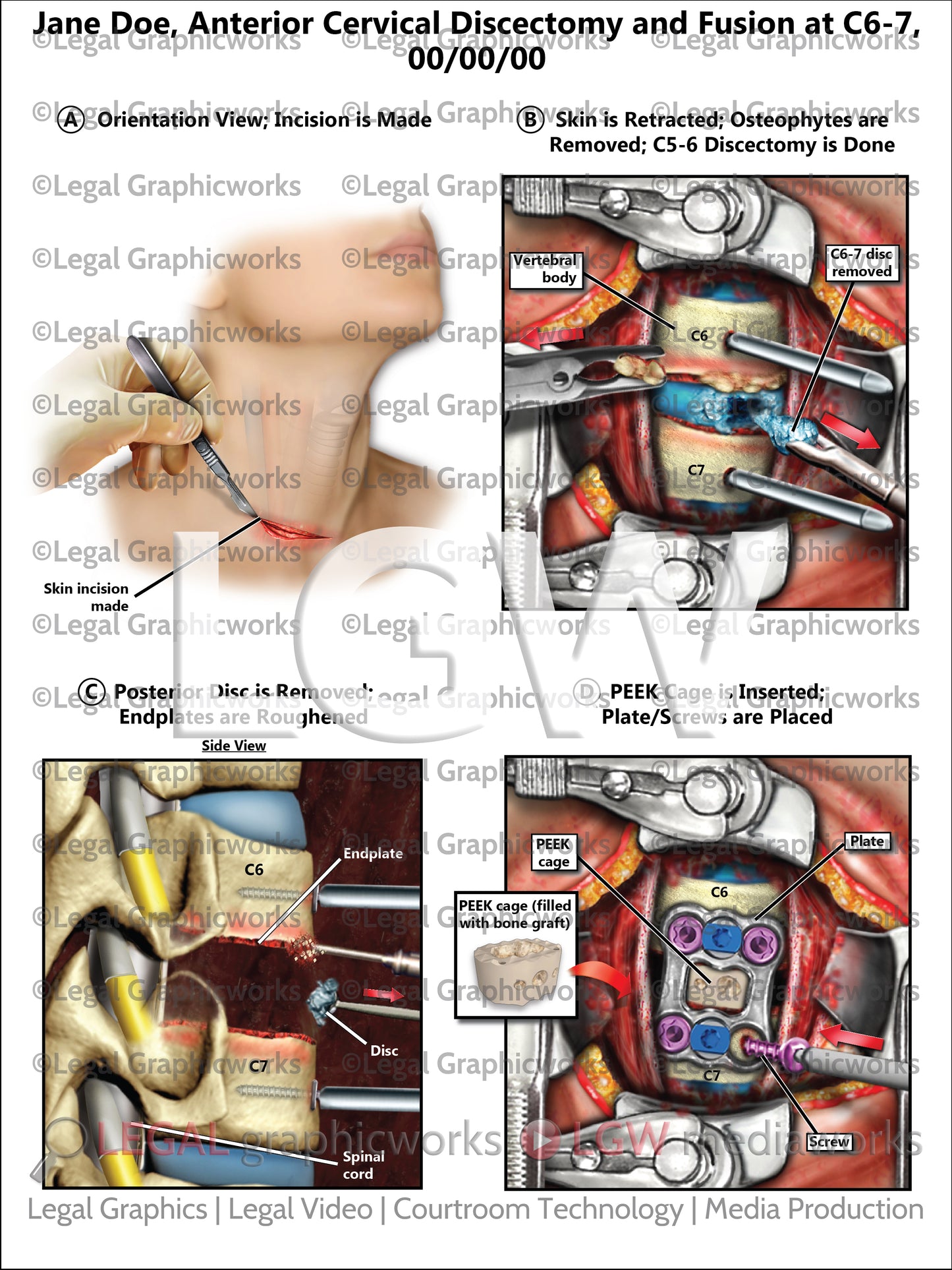 Anterior Cervical Discectomy and Fusion at C6-7