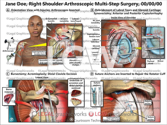 Right Shoulder Arthroscopic Multi-Step Surgery