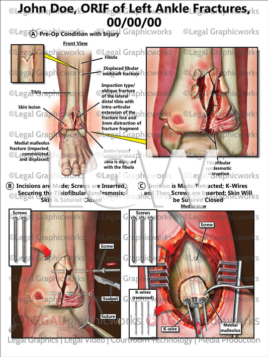 ORIF of Left Ankle Fractures
