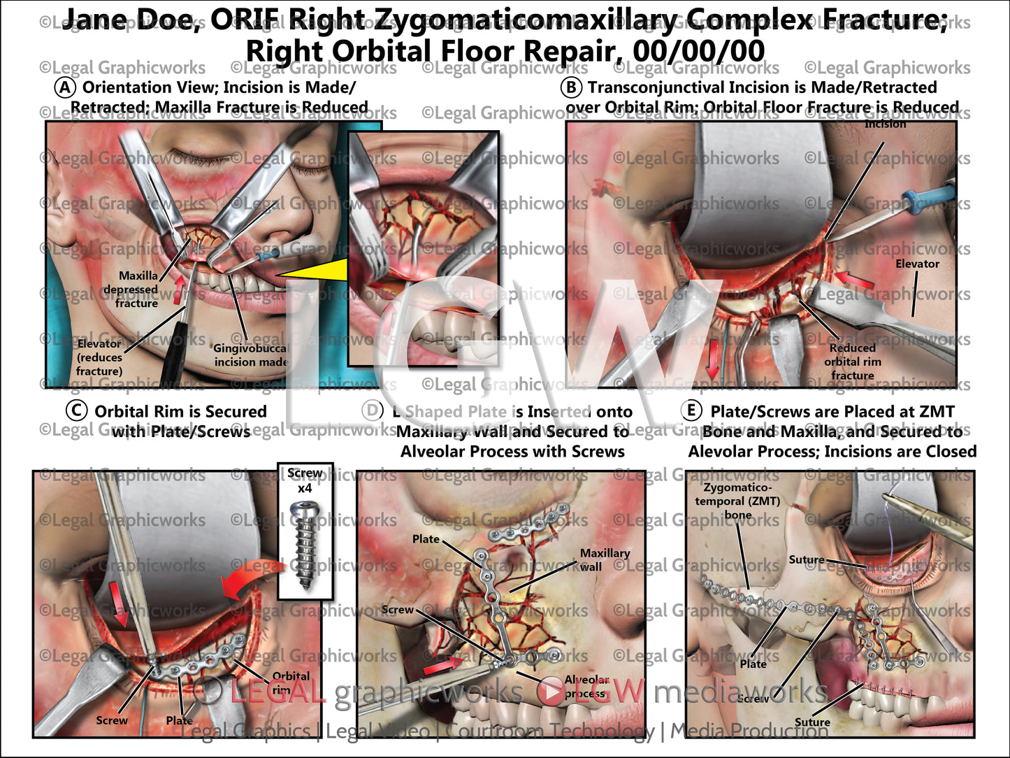 ORIF Right Zygomaticomaxillary Complex Fracture; Right Orbital Floor Repair