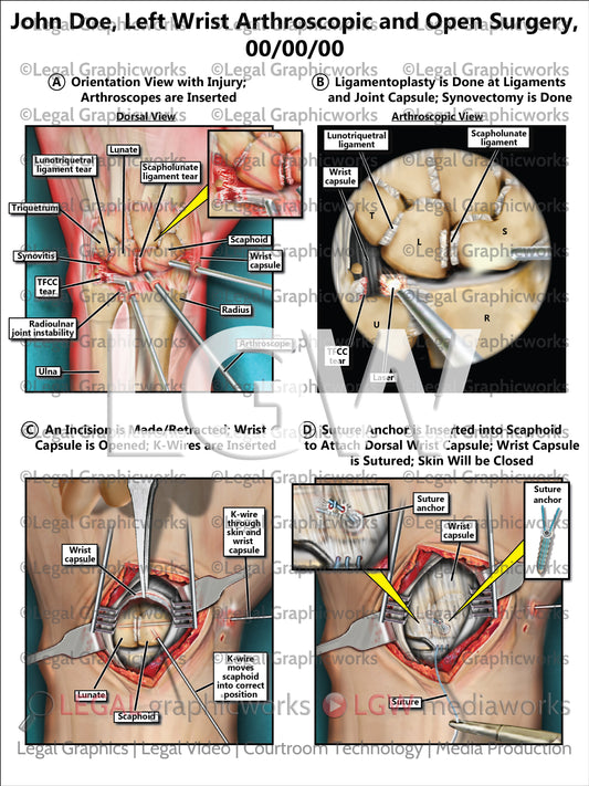Left Wrist Arthroscopic and Open Surgery