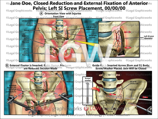 Closed Reduction and External Fixation of Anterior Pelvis; Left SI Screw Placement
