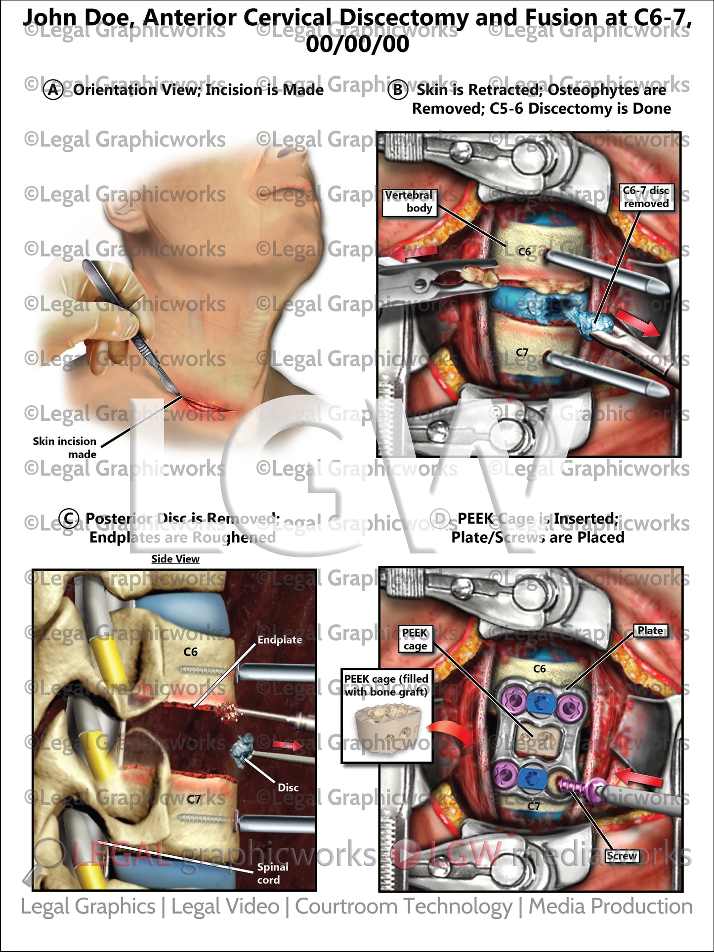 Anterior Cervical Discectomy and Fusion at C6-7