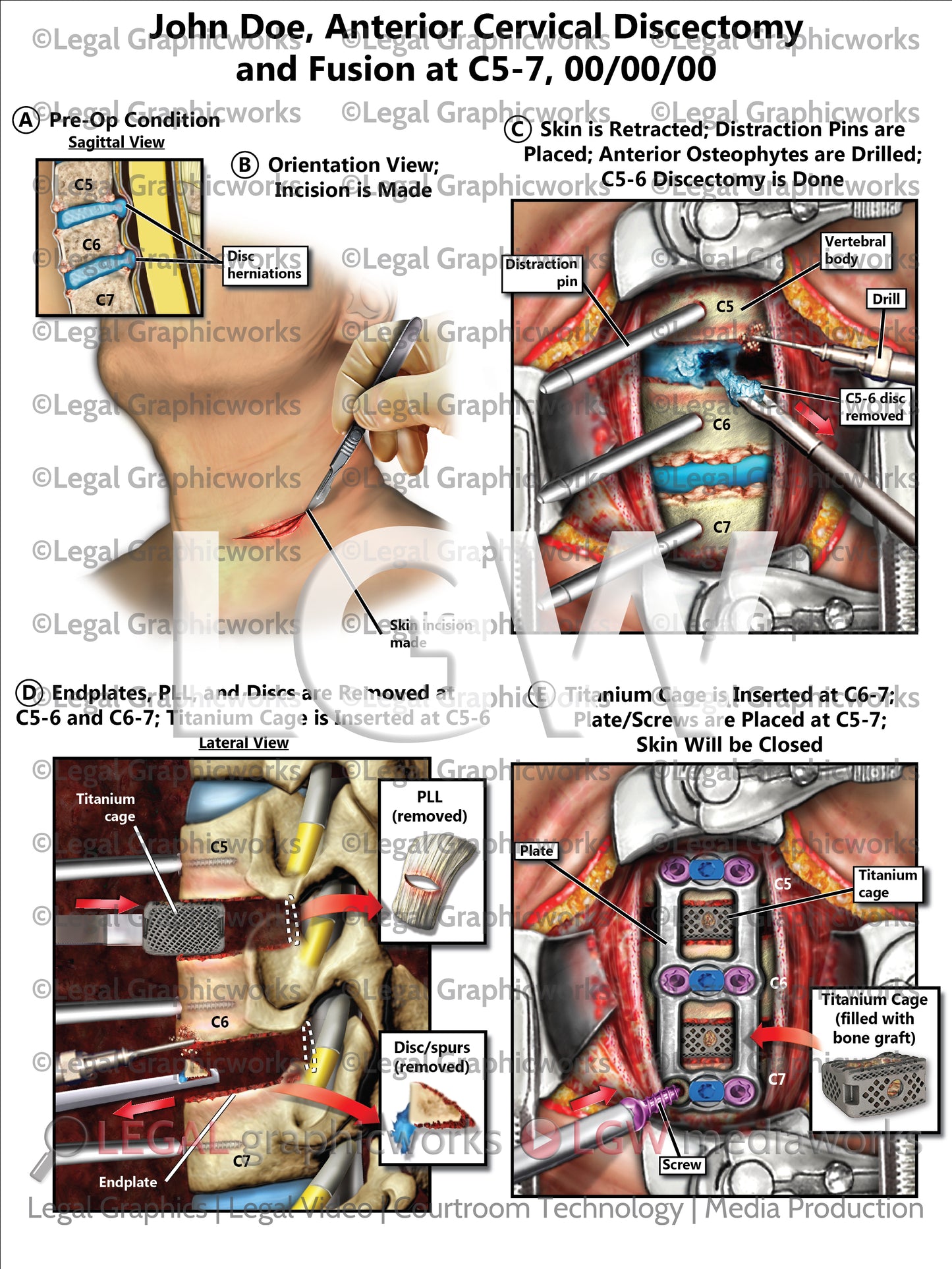 Anterior Cervical Discectomy and Fusion at C5-7