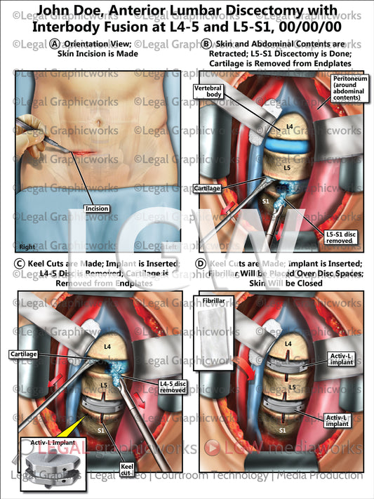 Anterior Lumbar Discectomy with Interbody Fusion at L4-5 and L5-S1