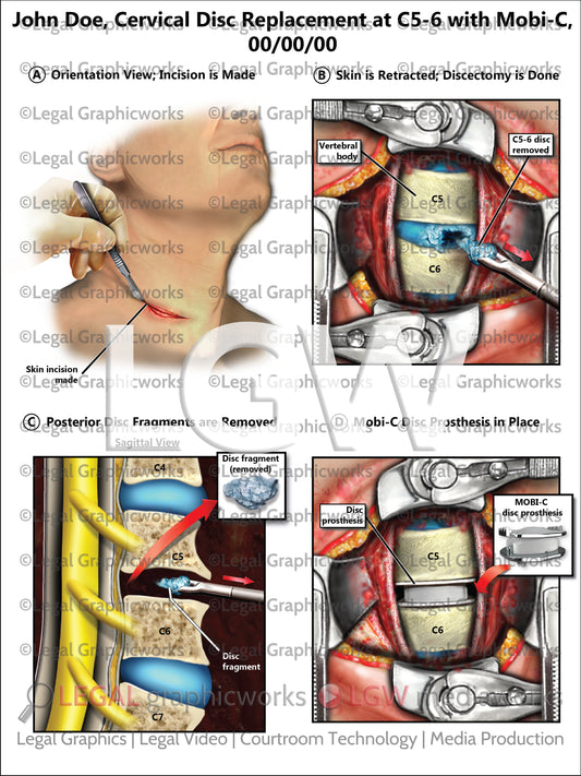 Cervical Disc Replacement at C5-6 with Mobi-C