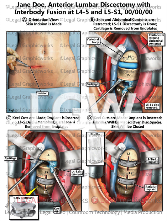 Anterior Lumbar Discectomy with Interbody Fusion at L4-5 and L5-S1