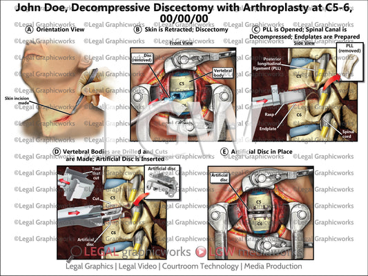 Decompressive Discectomy with Arthroplasty at C5-6