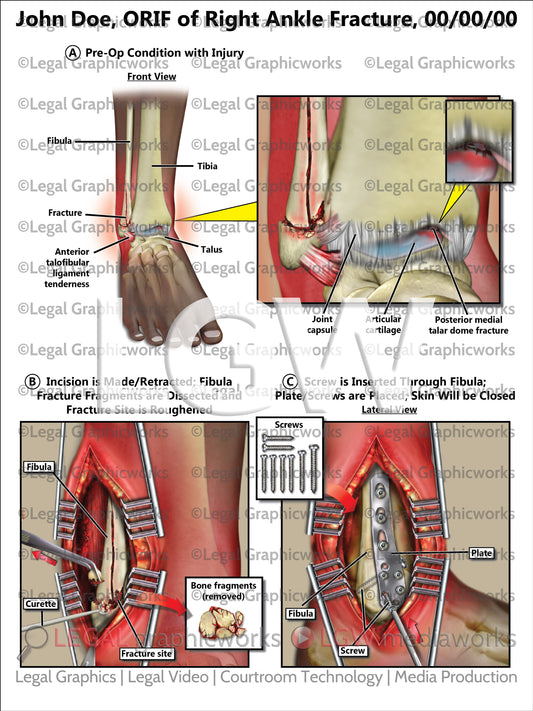ORIF of Right Ankle Fracture