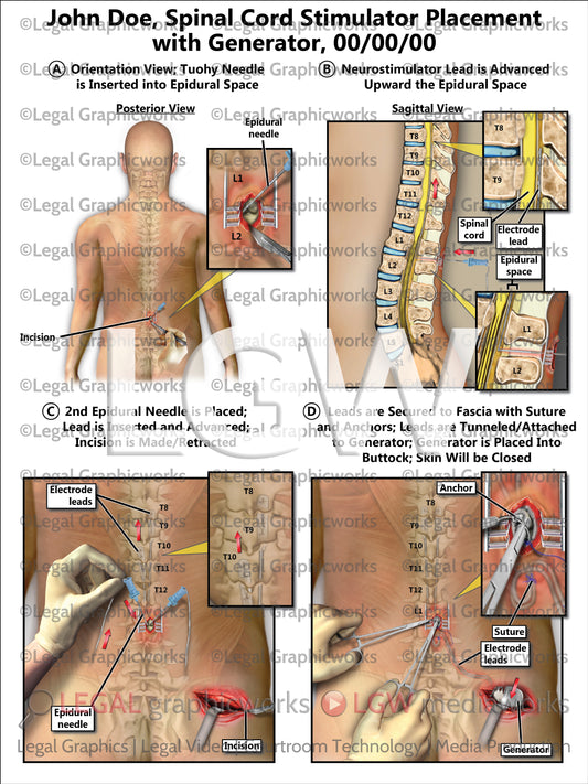 Spinal Cord Stimulator Placement with Generator