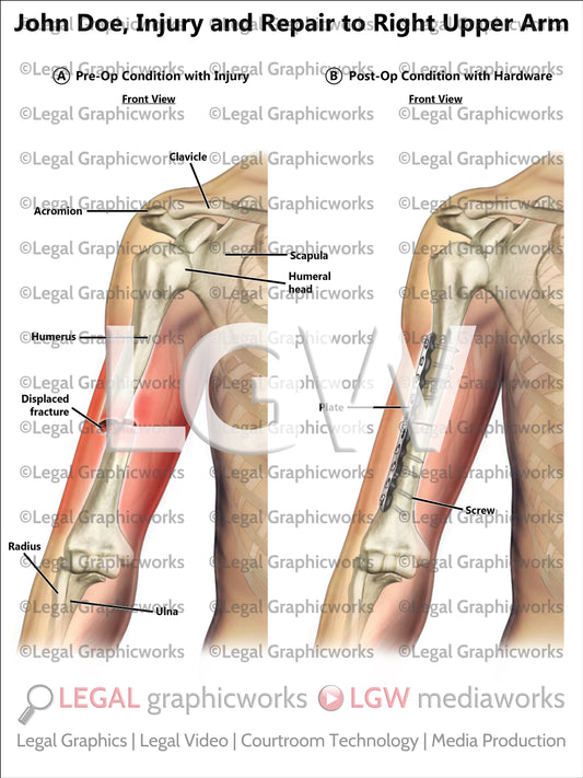 Injury and Repair to Right Upper Arm
