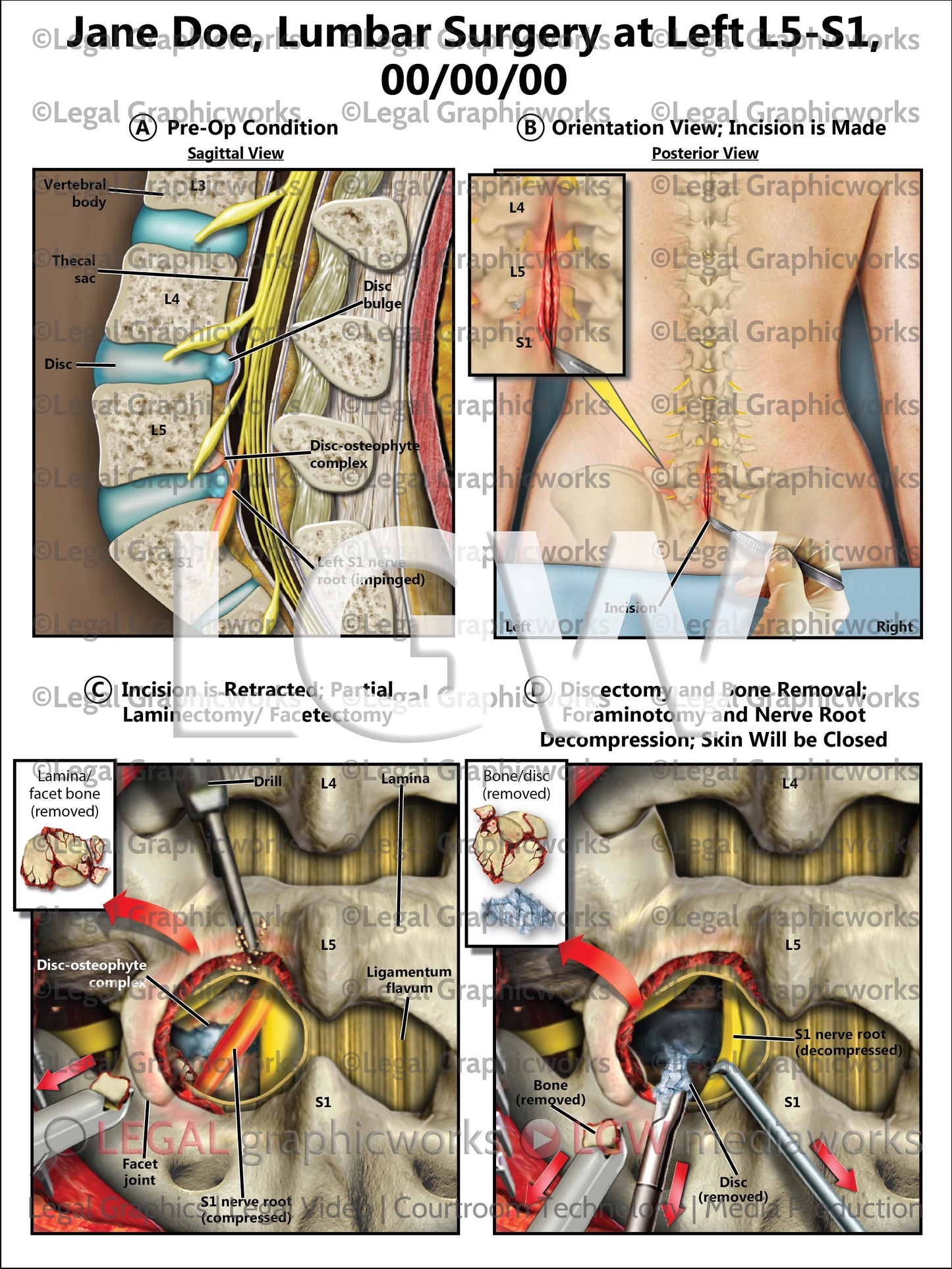 Lumbar Surgery at Left L5-S1