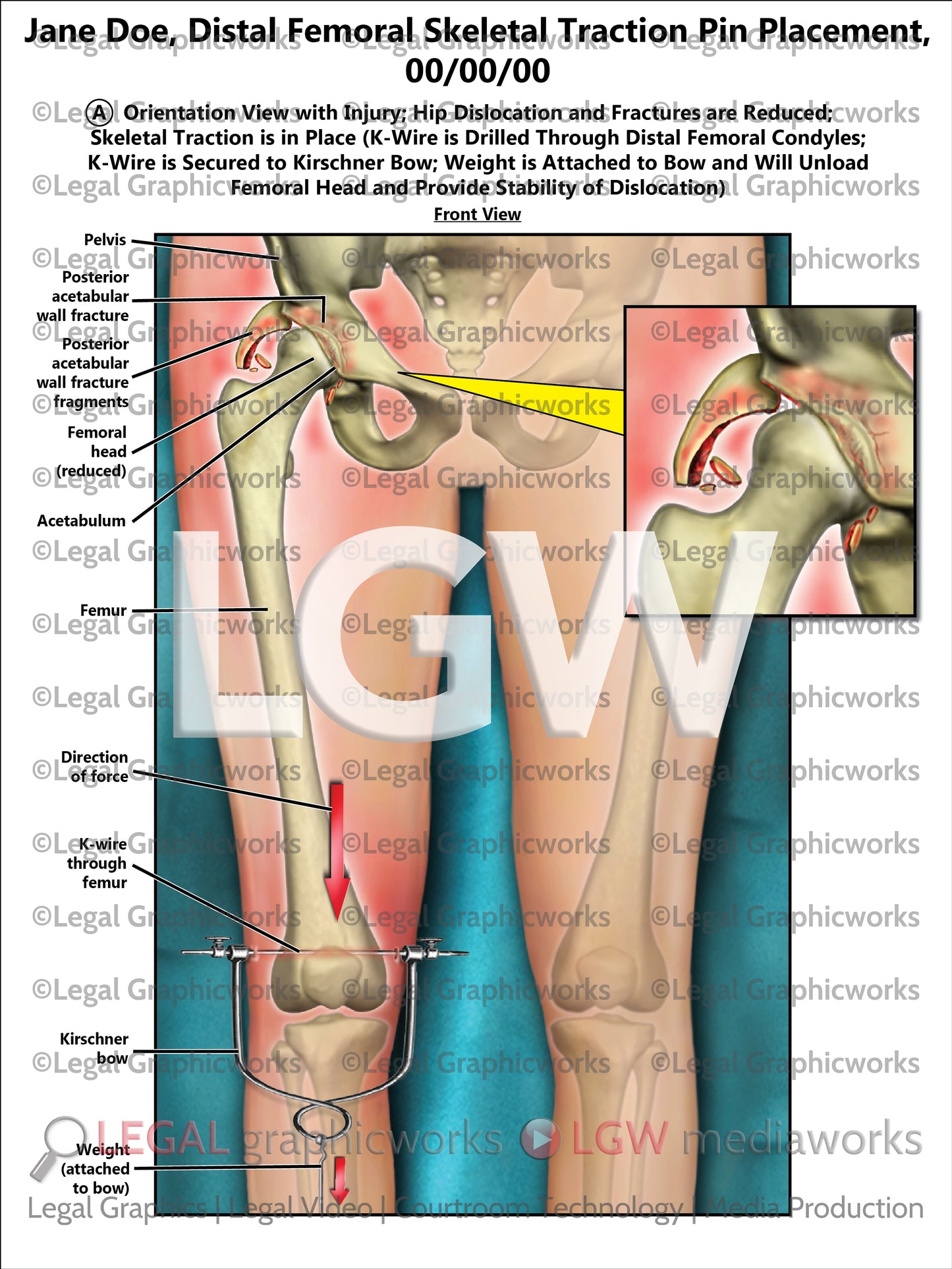 Distal Femoral Skeletal Traction Pin Placement