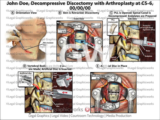 Decompressive Discectomy with Arthroplasty at C5-6