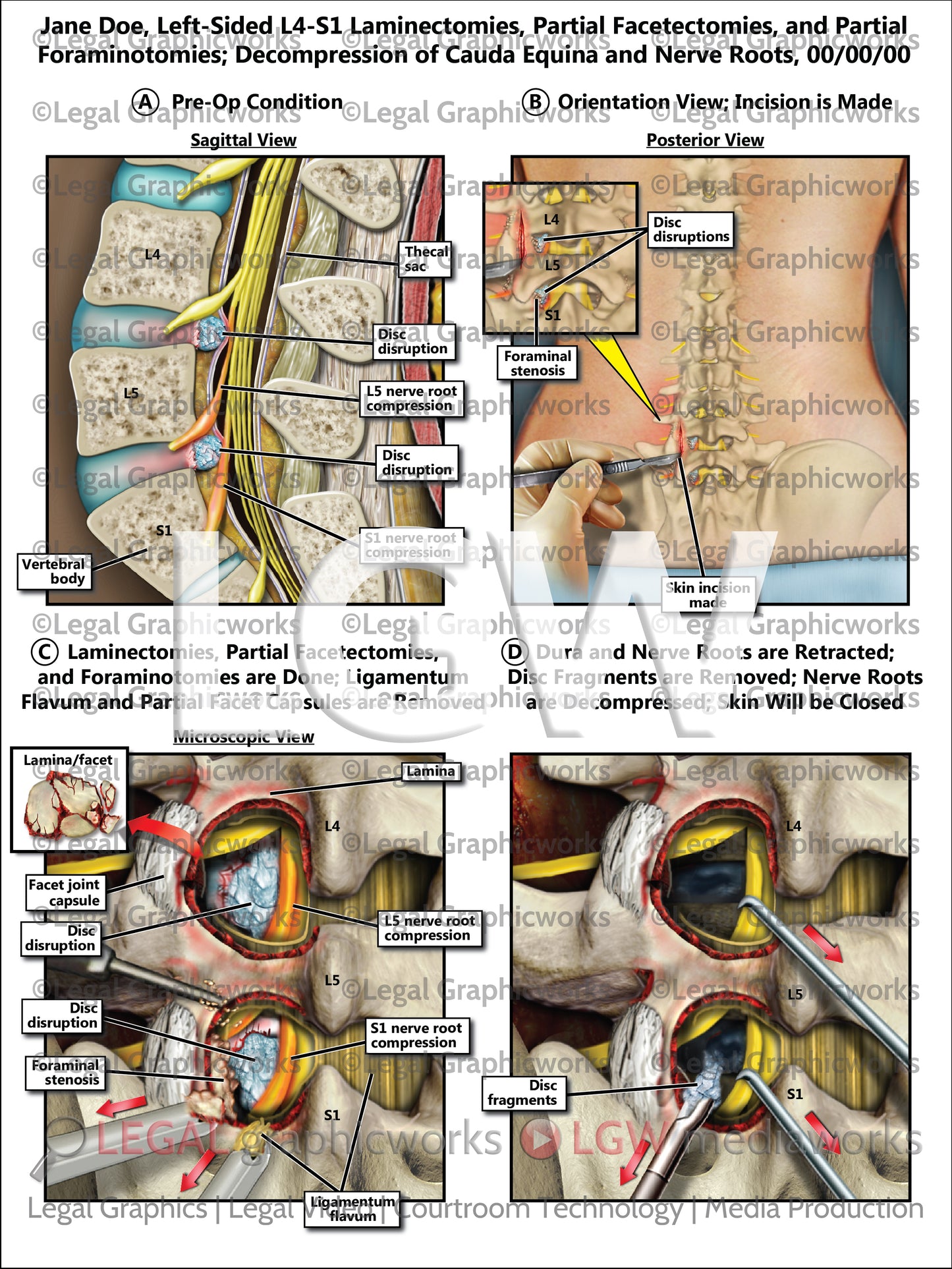 Left-Sided L4-S1 Laminectomies, Partial Facetectomies, and Partial Foraminotomies; Decompression of Cauda Equina and Nerve Roots