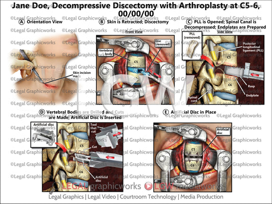 Decompressive Discectomy with Arthroplasty at C5-6
