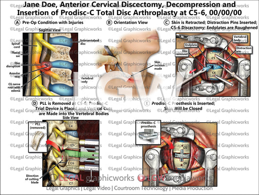 Anterior Cervical Discectomy, Decompression and Insertion of Prodisc-C Total Disc Arthroplasty at C5-6