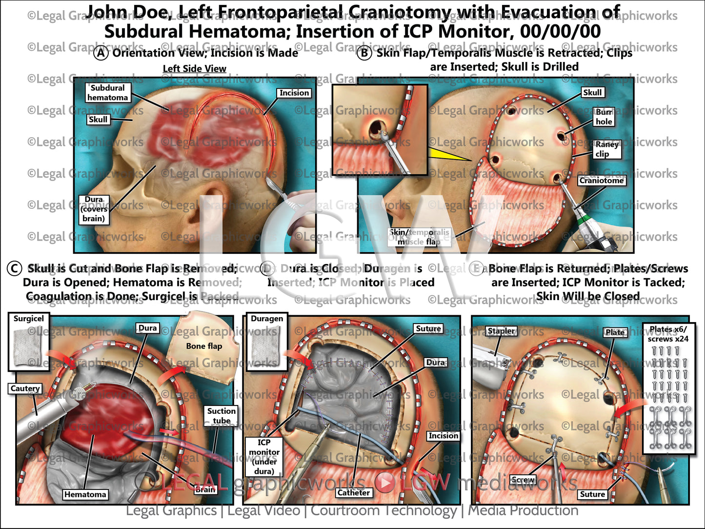 Left Frontoparietal Craniotomy with Evacuation of Subdural Hematoma; Insertion of ICP Monitor