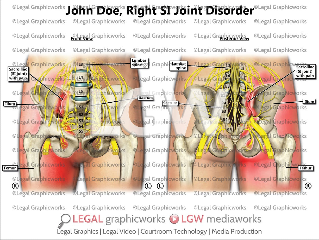 Right SI Joint Disorder