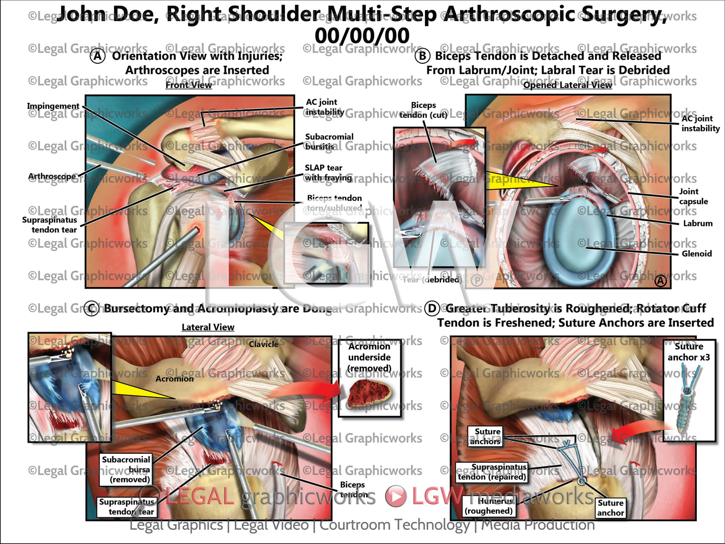 Right Shoulder Multi-Step Arthroscopic Surgery