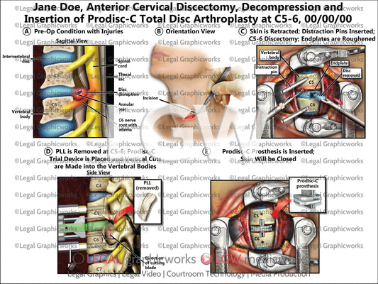 Anterior Cervical Discectomy, Decompression and Insertion of Prodisc-C Total Disc Arthroplasty at C5-6