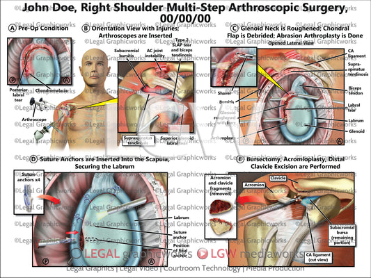 Right Shoulder Multi-Step Arthroscopic Surgery