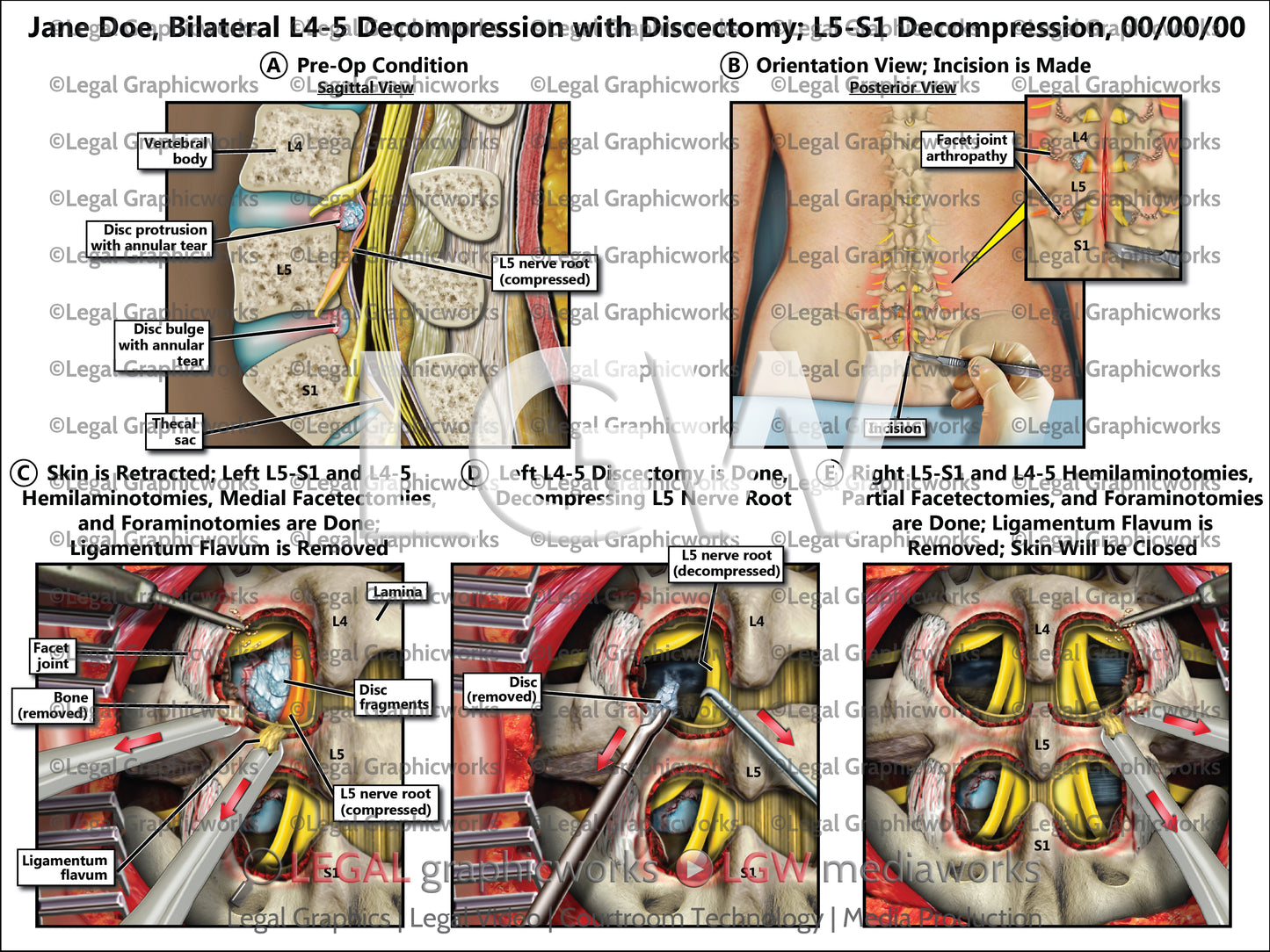 Bilateral L4-5 Decompression with Discectomy; L5-S1 Decompression
