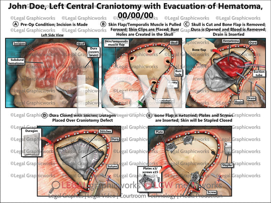 Left Central Craniotomy with Evacuation of Hematoma