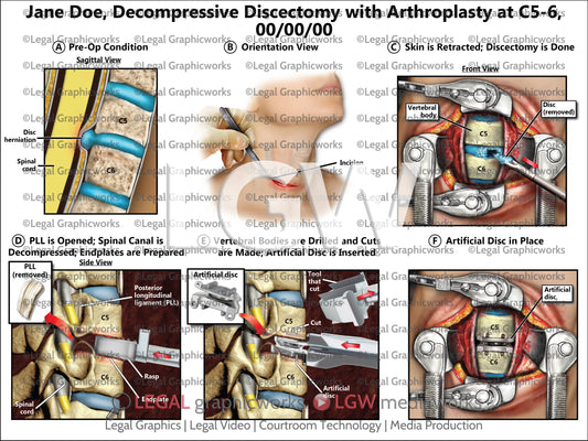 Decompressive Discectomy with Arthroplasty at C5-6