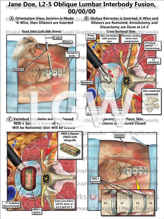 L2-5 Oblique Lumbar Interbody Fusion