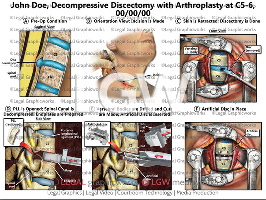 Decompressive Discectomy with Arthroplasty at C5-6