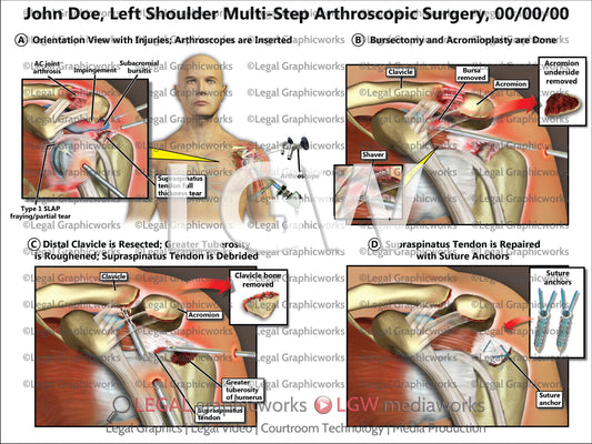 Left Shoulder Multi-Step Arthroscopic Surgery