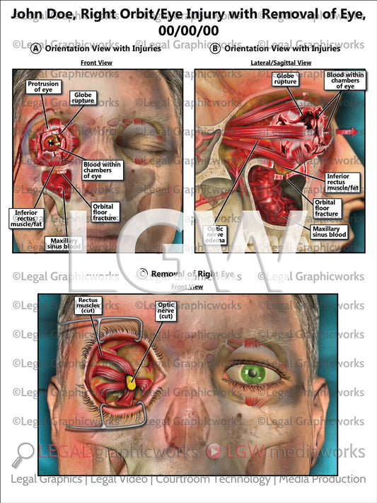 Right Orbit/Eye Injury with Removal of Eye