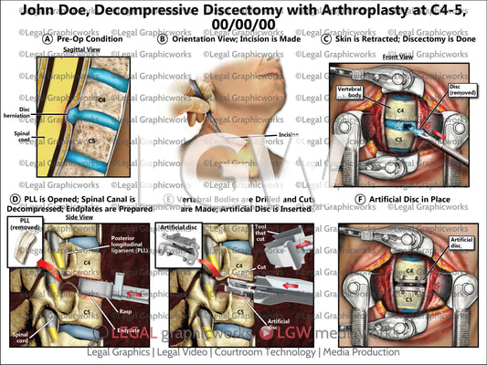 Decompressive Discectomy with Arthroplasty at C4-5
