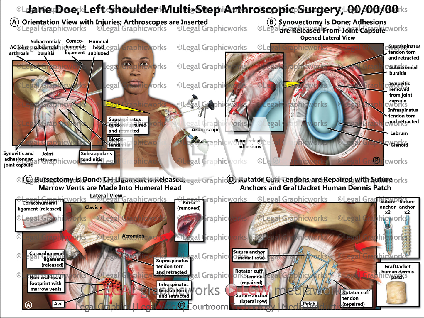 Left Shoulder Multi-Step Arthroscopic Surgery