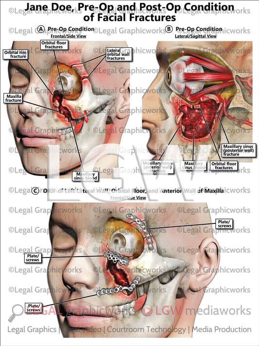 Pre-Op and Post-Op Condition of Facial Fractures