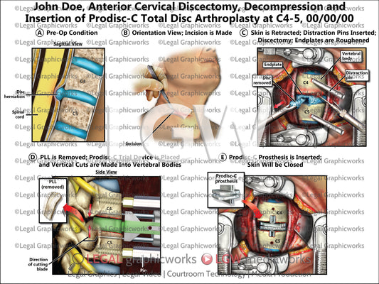 Anterior Cervical Discectomy, Decompression and Insertion of Prodisc-C Total Disc Arthroplasty at C4-5