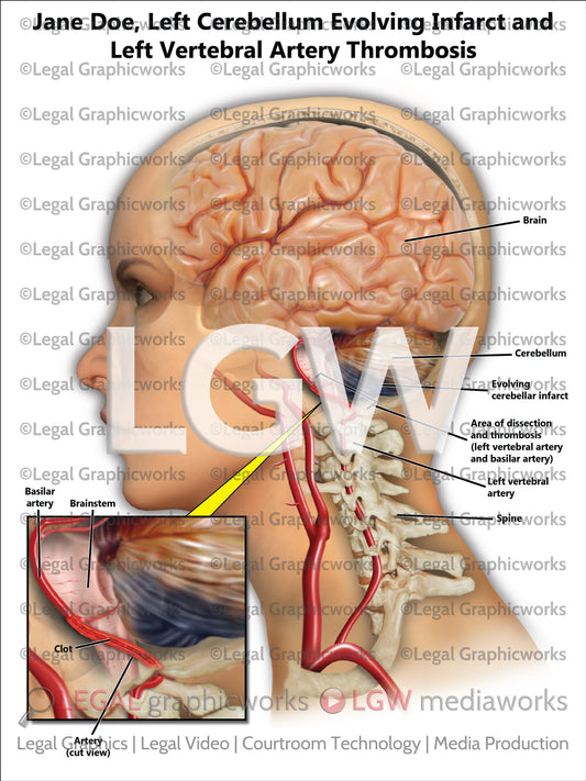 Left Cerebellum Evolving Infarct and Left Vertebral Artery Thrombosis