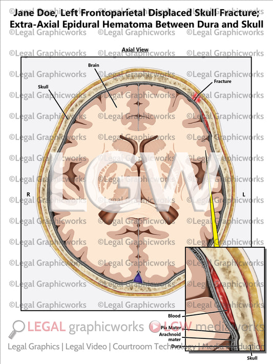 Left Frontoparietal Displaced Skull Fracture; Extra-Axial Epidural Hematoma Between Dura and Skull